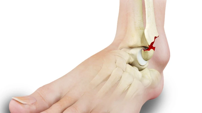 Gãy xương mắt cá chân là tình trạng một hoặc nhiều xương tạo nên khớp cổ chân bị nứt hoặc gãy do lực tác động mạnh