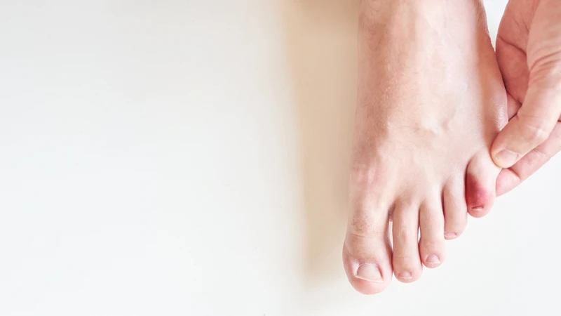 Đau nhói hoặc đau âm ỉ tại ở ngón chân bị tổn thương là một dấu hiệu gãy xương ngón chân