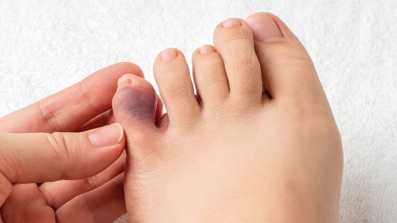 Sau chấn thương, hiện tượng tụ máu dưới da có thể khiến ngón chân chuyển sang màu đỏ sậm, tím hoặc xanh