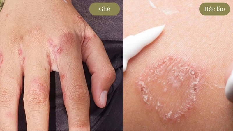 Ghẻ lở hắc lào​: Dấu hiệu và cách phân biệt  1