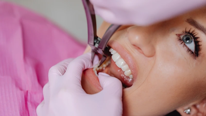 Tìm hiểu giá nhổ răng hàm bị sâu hiện nay