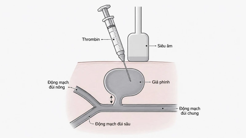 Thrombin được đưa trực tiếp vào túi giả phình nhằm tạo huyết khối và làm ngừng dòng máu trong túi