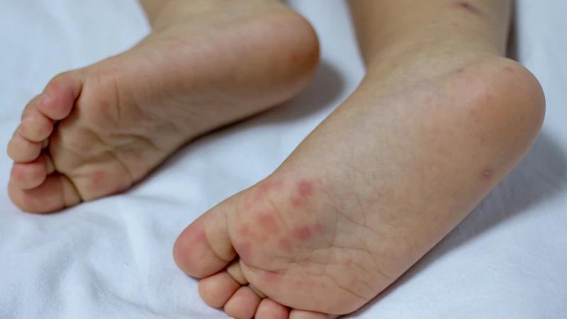 Trẻ có biểu hiện tay chân miệng, ưu tiên hình tổn thương ở bàn tay, bàn chân hoặc miệng
