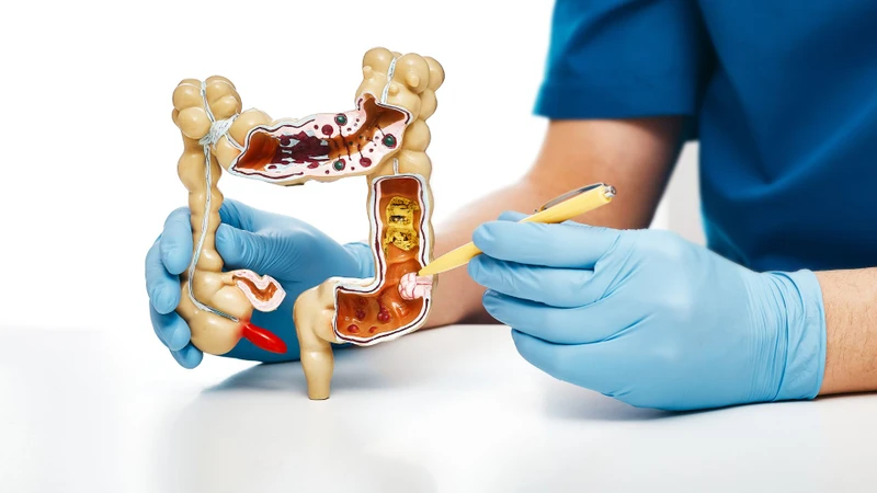 Giải đáp chi phí cắt polyp đại tràng và các yếu tố quyết định 1