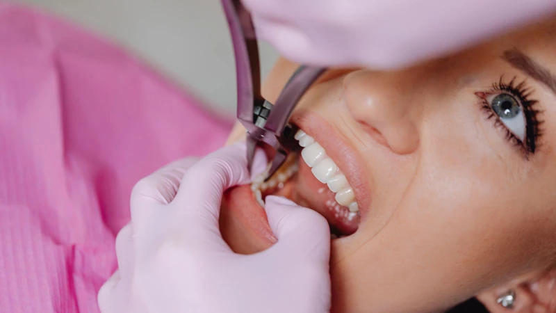 Giá nhổ răng khôn bảo hiểm y tế bao nhiêu tiền?