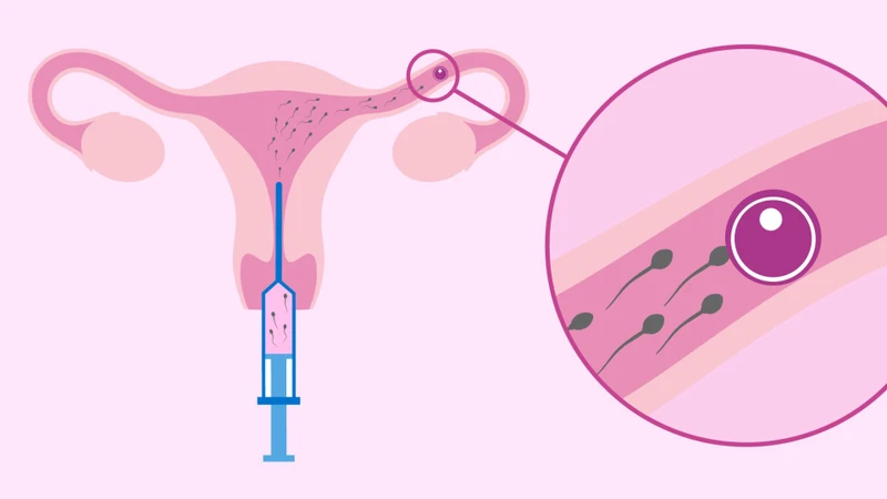IUI thường được chỉ định trong trường hợp vòi trứng thông hạn chế nhẹ