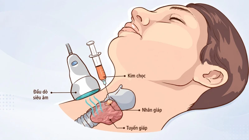 Chọc hút tế bào bằng kim nhỏ dưới hướng dẫn của siêu âm