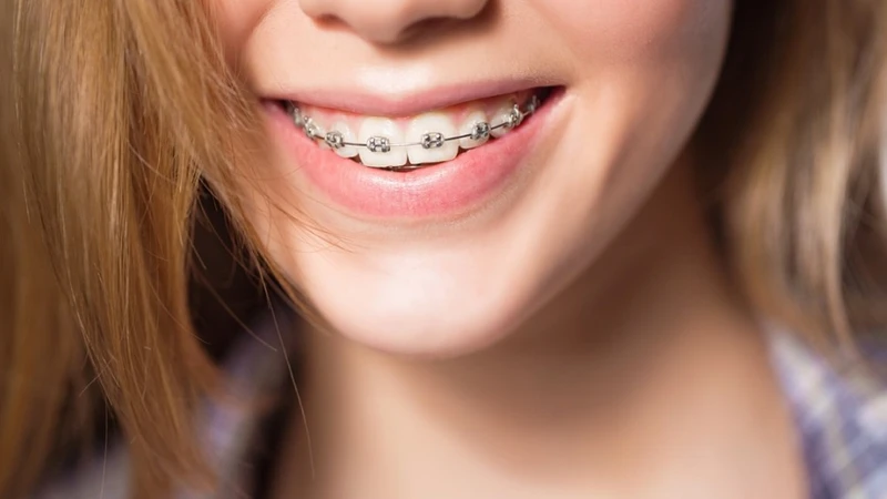 Giai đoạn xấu nhất khi niềng răng là khoảng 2 - 3 tháng đầu sau chỉnh nha