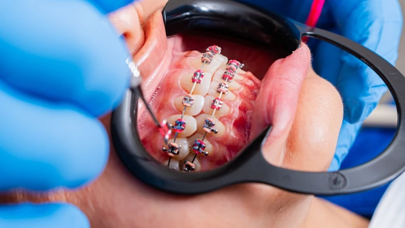Nha sĩ sẽ liên tục điều chỉnh lực kéo để răng đi đúng hướng