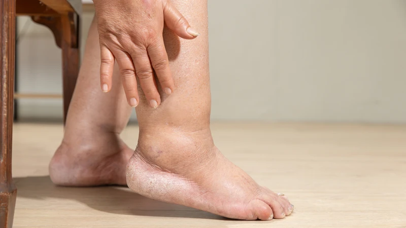 Suy tĩnh mạch mạn tính có thể gây ra phù chân, đau nhức và loét da