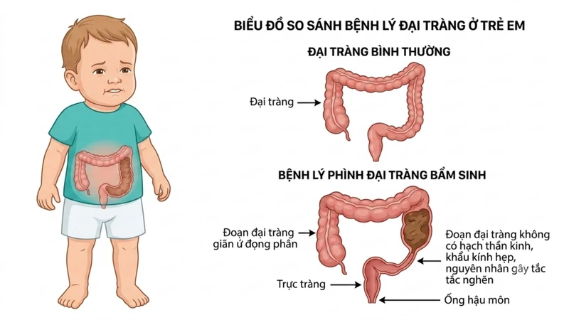 Chậm đi phân su và bụng chướng là dấu hiệu thường gặp ở trẻ mắc bệnh
