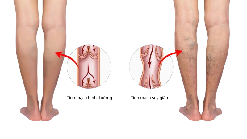 Giãn tĩnh mạch ngoằn ngoèo