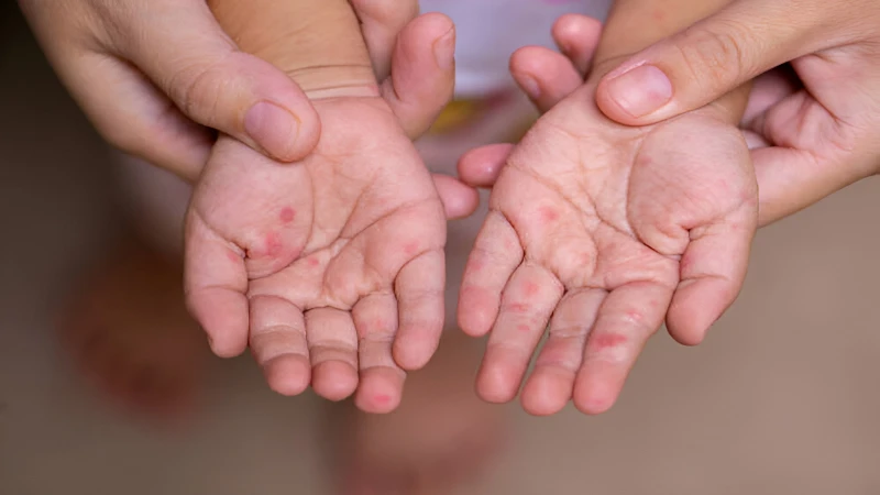 Giật mình tay chân miệng ở trẻ em: Dấu hiệu cảnh báo biến chứng nguy hiểm? 2
