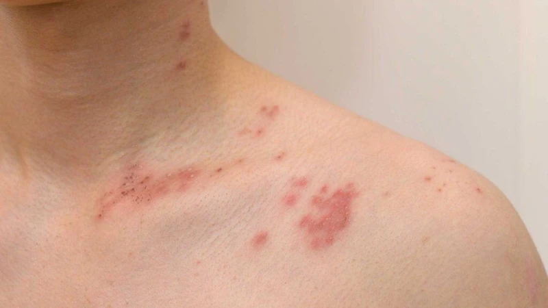 Giời leo có để lại sẹo không? Cách chăm sóc tránh để lại sẹo 4
