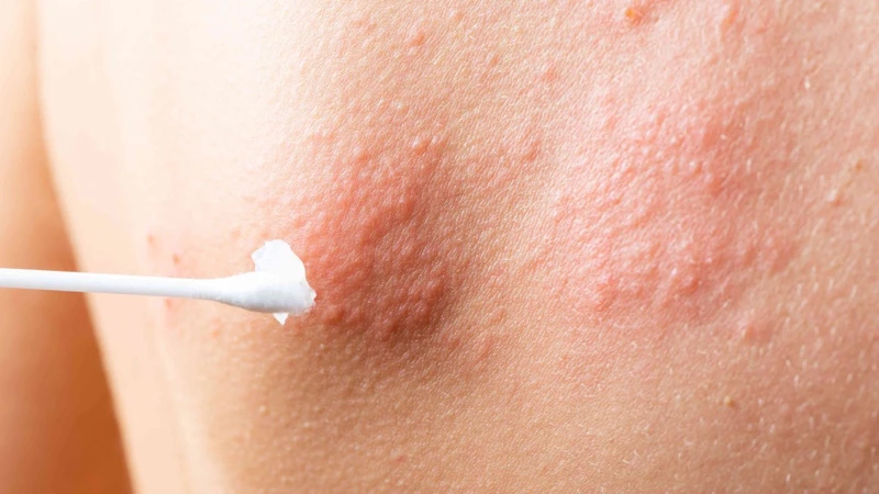 Giời leo có để lại sẹo không? Cách chăm sóc tránh để lại sẹo 2