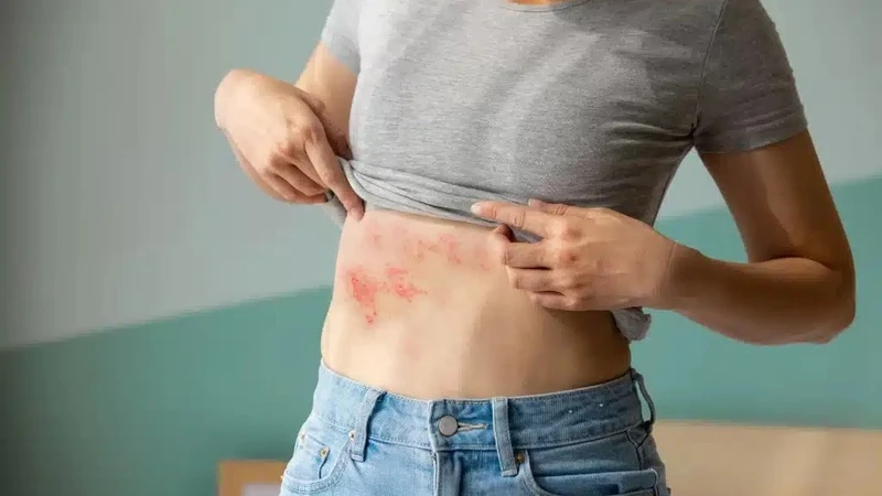 Giời leo có lây không? Cách phòng tránh lây nhiễm hiệu quả 3