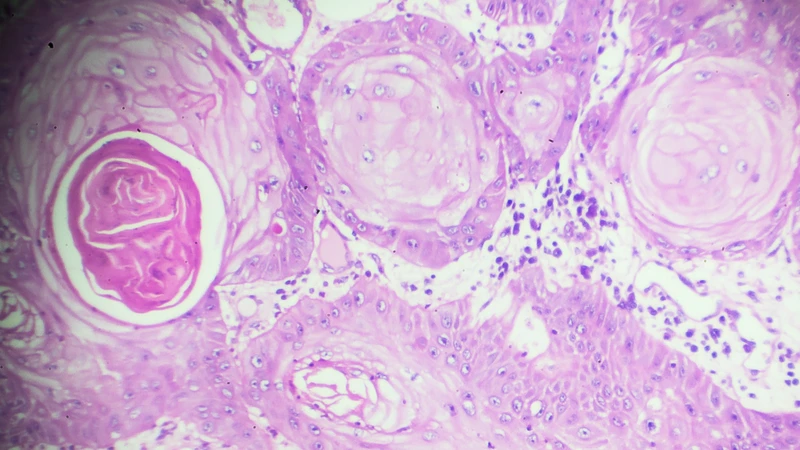 Hạch di căn carcinoma gây ra nhiều dấu hiệu như hạch cứng, to nhanh và suy giảm thể trạng