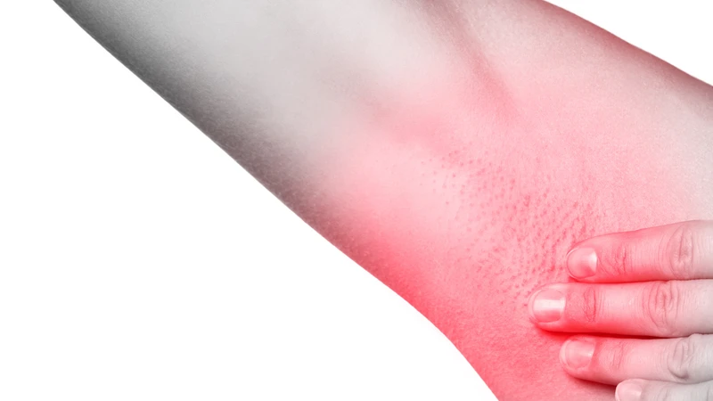 Nổi hạch ở nách có thể do nhiều nguyên nhân, từ nhiễm trùng thông thường đến bệnh lý phức tạp