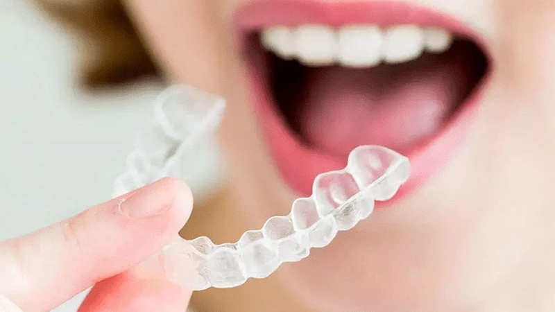 Thời gian đeo hàm duy trì sẽ được bác sĩ điều chỉnh theo từng giai đoạn