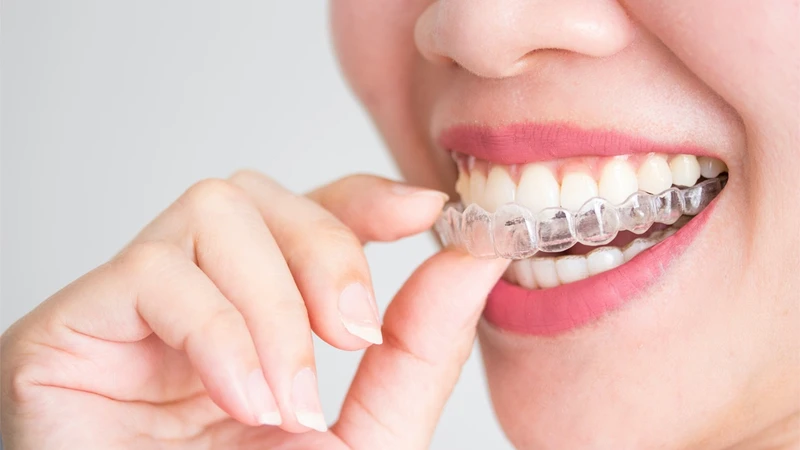 Hàm duy trì trong suốt được thiết kế ôm sát khuôn răng sau tháo niềng nhằm cố định vị trí mới của răng