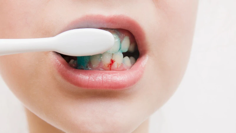 Đánh răng nhẹ nhưng vẫn chảy máu thể bạn đang gặp vấn đề nướu nghiêm trọng