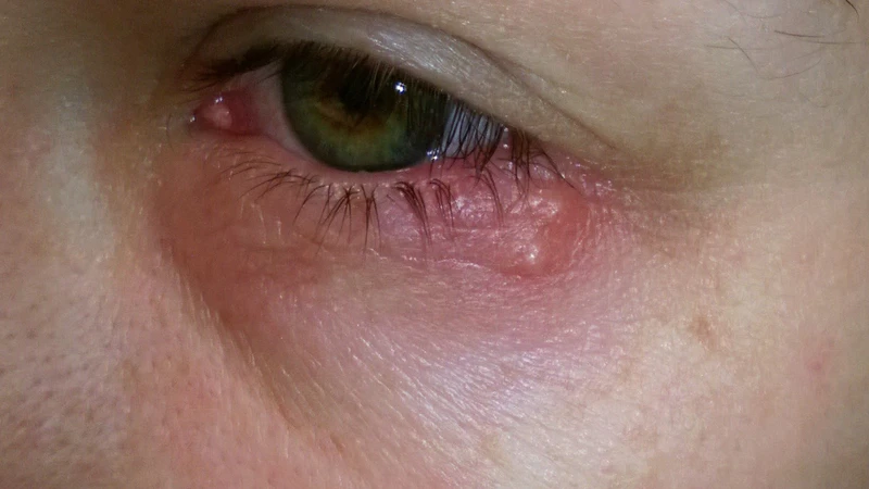 Herpes simplex virus type 1 và type 2 có ảnh hưởng lớn đến sức khỏe