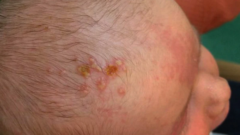 HSV 1 có thể xảy ra ở trẻ em