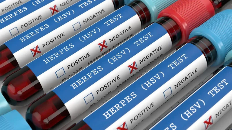 Herpes sinh dục là gì? Nguyên nhân, triệu chứng và cách điều trị 4
