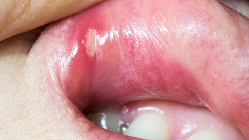 Hình ảnh bệnh tay chân miệng cấp độ 2: Dấu hiệu nhận biết và cảnh báo biến chứng 4