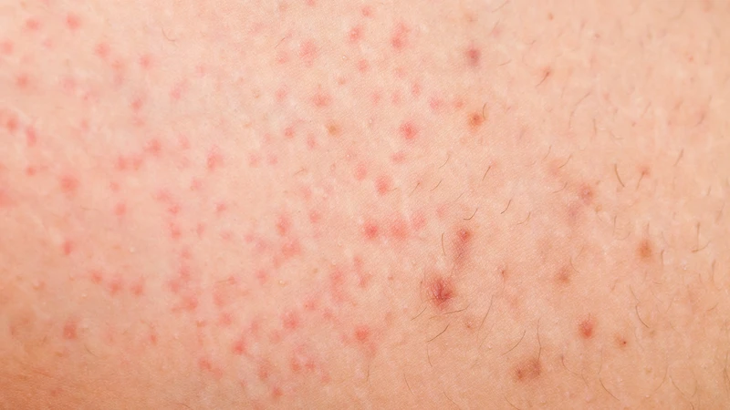 Nhận diện hình ảnh viêm nang lông nông
