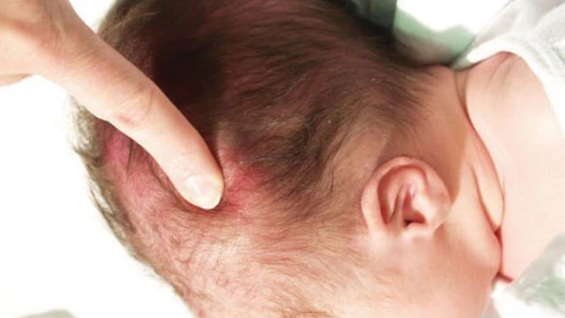Khi sờ vào khối sưng, cha mẹ sẽ nhận thấy vùng da đầu mềm, ấn vào có cảm giác lõm nhẹ, không gồ ghề hay cứng chắc