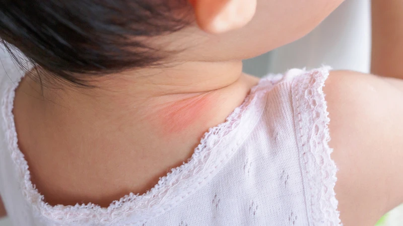 Hình ảnh hăm cổ ở trẻ sơ sinh và cách điều trị hiệu quả 1