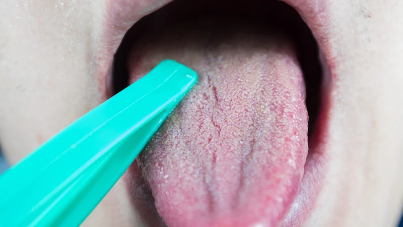 Hình ảnh mô phỏng viêm amidan quá phát độ 2 chiếm gần một nửa khoang họng