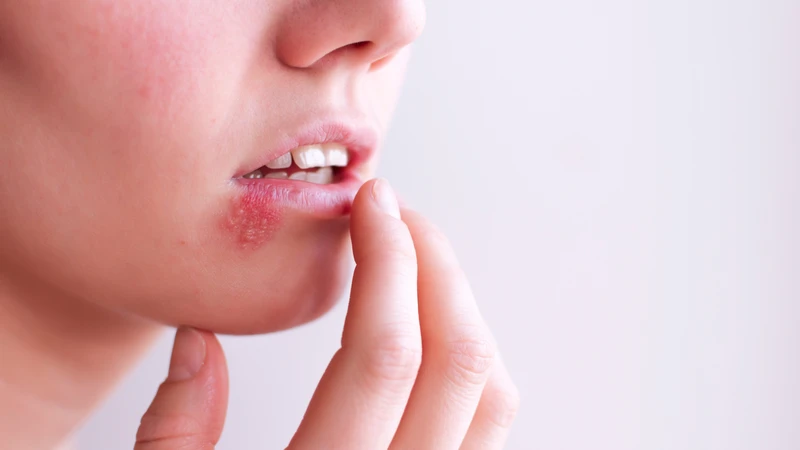 Herpes miệng gây mụn nước li ti ở môi và miệng, dễ tái phát