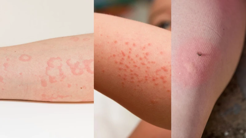 So sánh trực quan giúp phân biệt mề đay với rôm sảy và vết côn trùng đốt dựa trên hình dạng và đặc điểm tổn thương