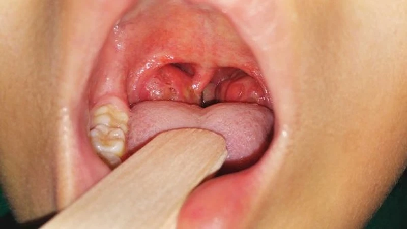 So sánh hình ảnh trước và sau khi cắt amidan