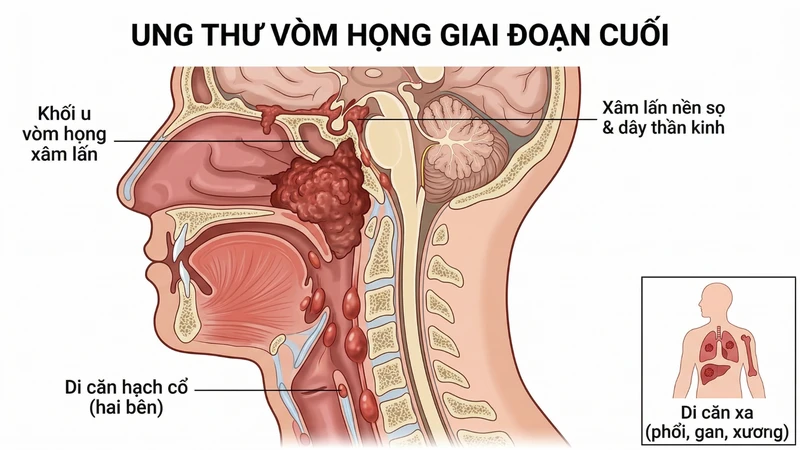 Hình ảnh ung thư vòm họng giai đoạn cuối thể hiện khối u lan rộng