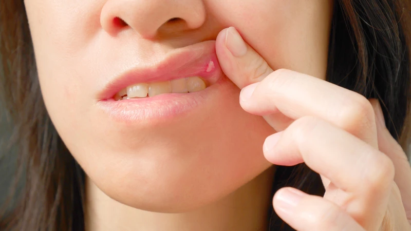 Hình ảnh viêm niêm mạc miệng có nhiều hình thái khác nhau