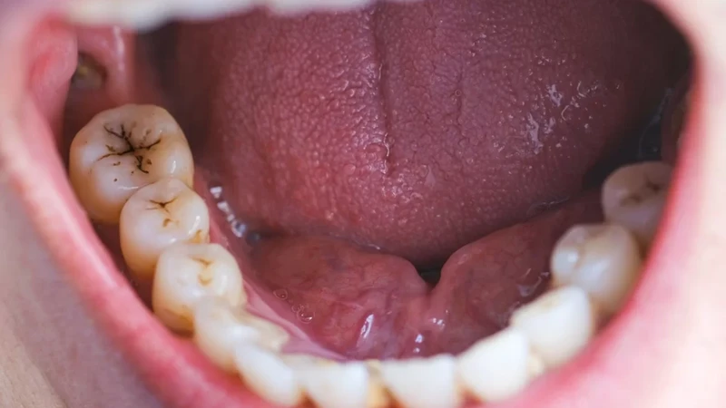 Sâu răng không được điều trị có thể lan vào tủy, gây đau nhức và khó chịu kéo dài