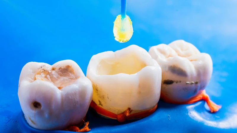 Viêm tủy răng thường gây đau nhức dữ dội
