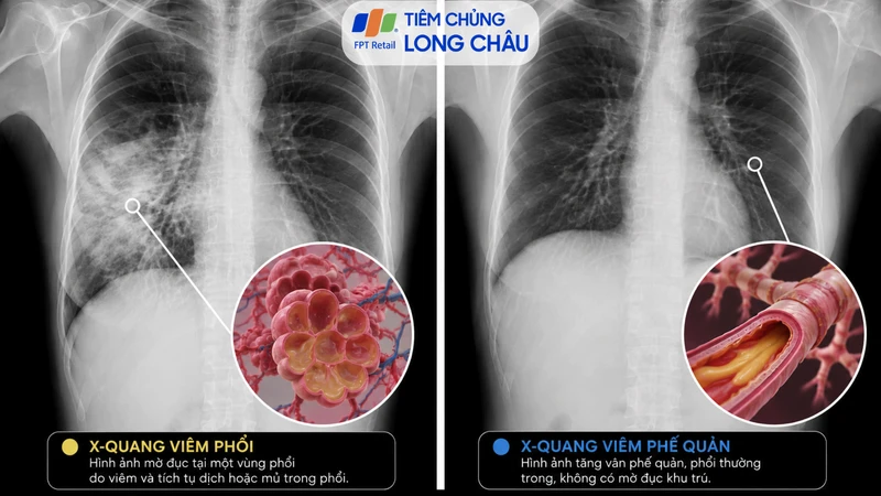 X-quang giúp phân biệt tổn thương do viêm phổi và viêm phế quản