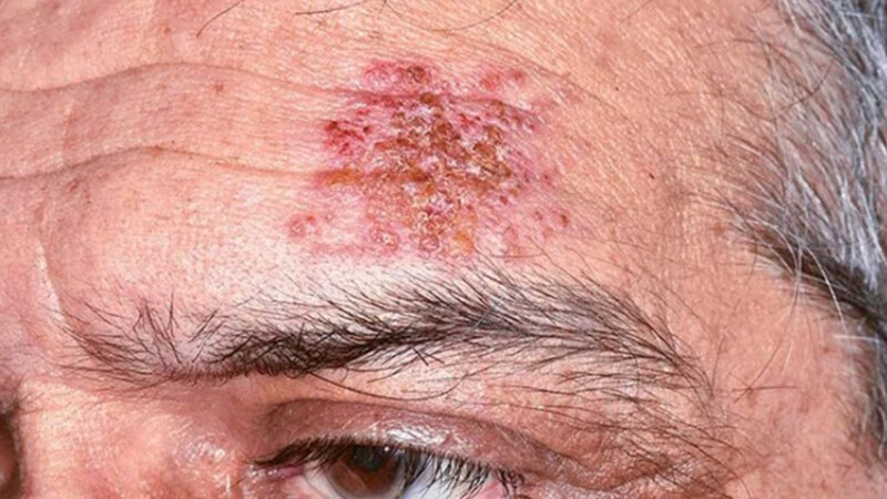 Hình ảnh zona thần kinh ở mặt theo các giai đoạn 4