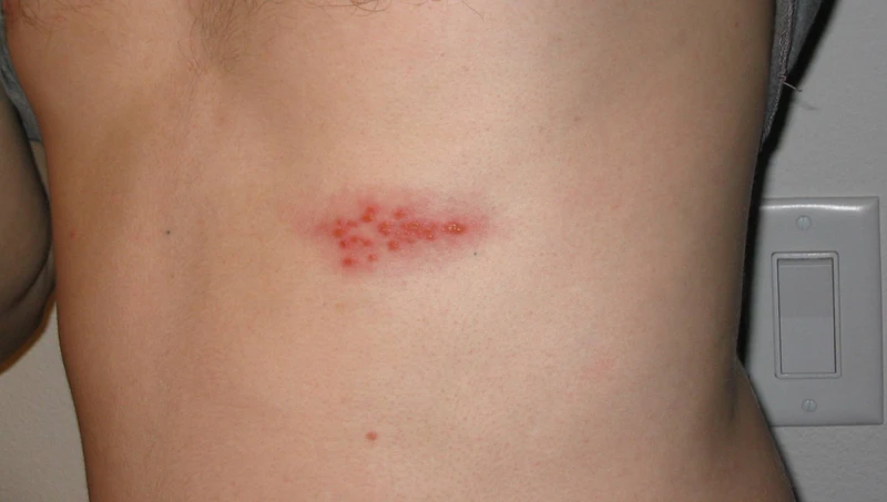 HIV lây qua đường nước bọt không? 3