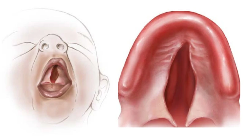 Hở hàm ếch bên trong là một dạng dị tật bẩm sinh khó nhận biết
