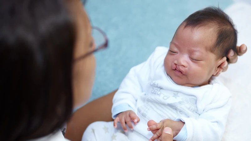 Hở hàm ếch có di truyền không? Nguy cơ có thể tăng nhưng không chắc chắn truyền từ cha mẹ sang con
