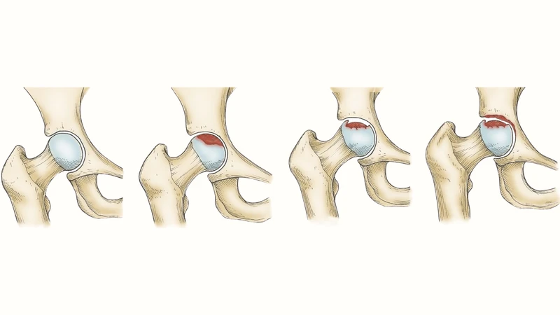 Hoại tử chỏm xương đùi có thể gây biến dạng khớp háng nếu không được điều trị kịp thời