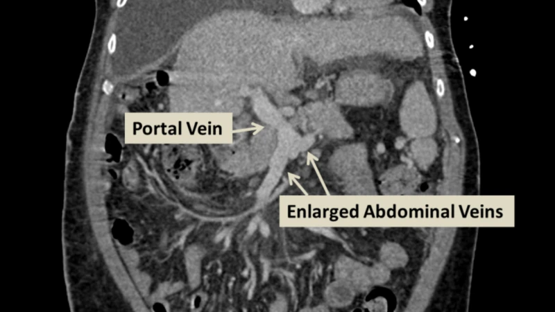 Hình ảnh CT scan của hội chứng tăng áp lực tĩnh mạch cửa