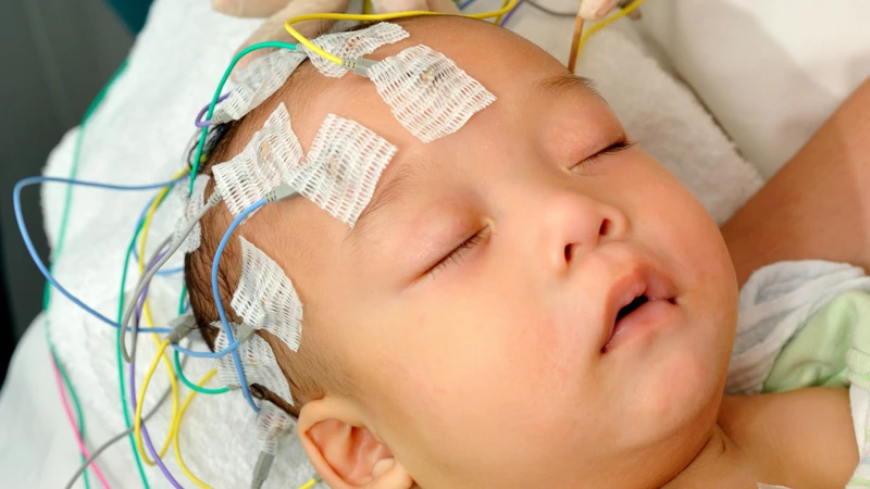 Điện não đồ là xét nghiệm quan trọng nhất, giúp phát hiện hình ảnh loạn nhịp cao thế hoặc các biến thể