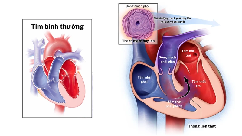 Hội chứng Eisenmenger là biến chứng nghiêm trọng của các dị tật tim