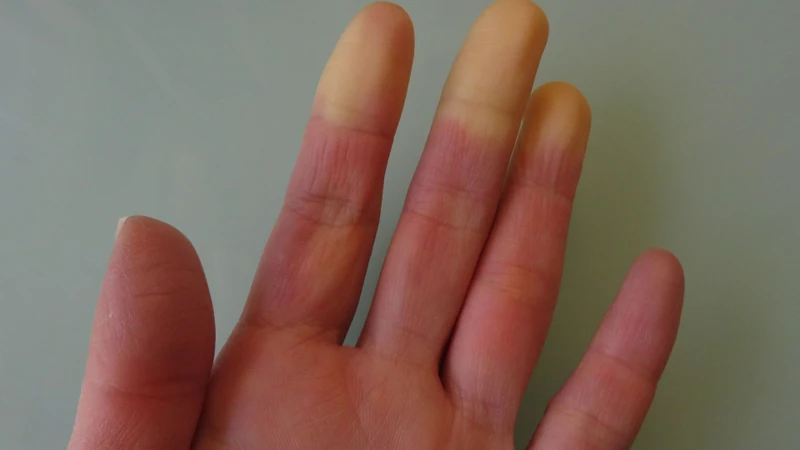 Hội chứng Raynaud: Nguyên nhân, triệu chứng và cách điều trị hiệu quả 2